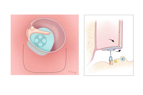 Ossiculoplasty Placement Technique – Oto Surgery Atlas