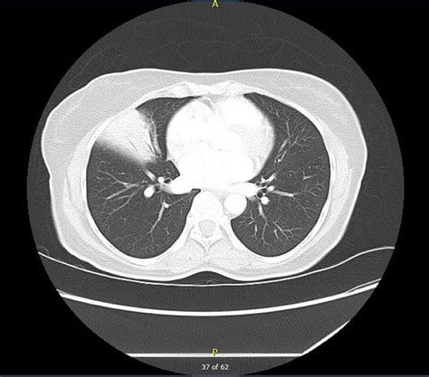 Right Middle Lobe Single Pulmonary Opacity With Air Bronchogram: A Problem-Solving Case Report ...