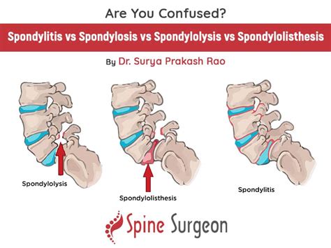 Are You Confused? Spondylitis vs Spondylosis vs Spondylolysis vs Spondylolisthesis By Dr Surya ...