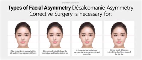 Facial Asymmetry Correction Surgery - Dream Plastic Surgery