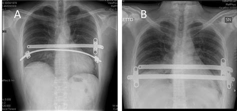 Frontiers | Nuss Technique for Pectus Excavatum in Adult Patients: Cosmetic Satisfaction and ...