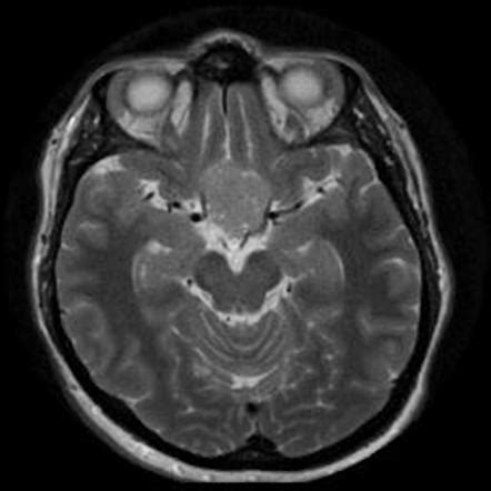 Suprasellar meningioma | Image | Radiopaedia.org