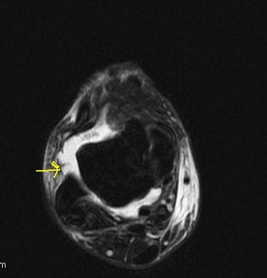 Anterior talofibular ligament (ATFL) Disruption-MRI - Sumer's Radiology ...