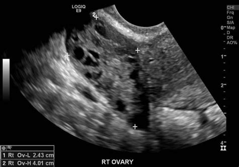 Ultrasound: Ovarian Torsion — BROWN EMERGENCY MEDICINE