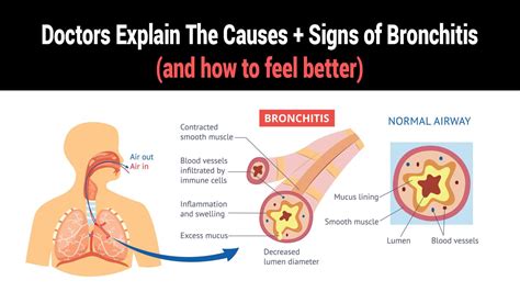 Doctors Explain The Causes + Signs of Bronchitis (and how to feel better)