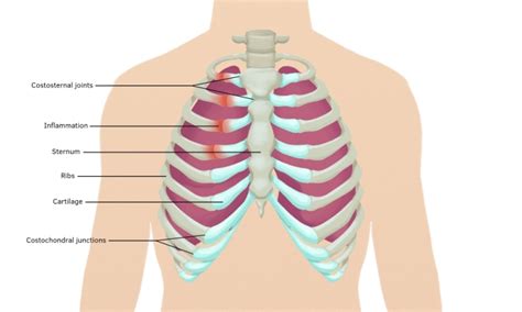 Chest Pain Treatment in Gurgaon | Chest Pain Physiotherapy Gurgaon