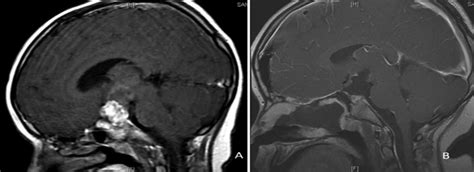 Case 5. Resection of suprasellar craniopharyngioma. A: Preoperative... | Download Scientific Diagram