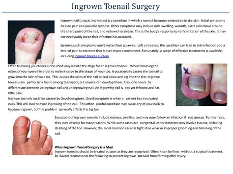 Ingrown Toenail Surgery PowerPoint Presentation PPT