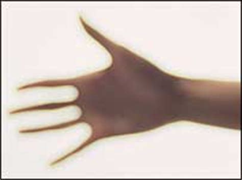 BBC NEWS | UK | Magazine | How to reattach severed fingers?