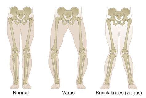 Knee Osteotomy - Sydney Knee Specialists