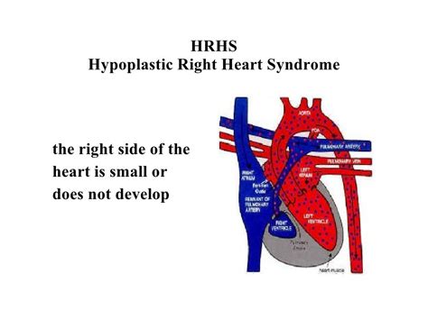 HRHS Hypoplastic Right Heart Syndrome