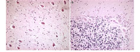 a The large cells of the dentate nucleus are almost consistently PAS ...