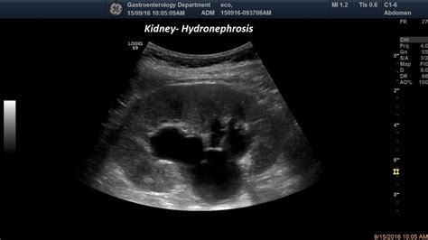 Hydronephrosis [1 image] – EFSUMB