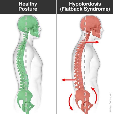 Posture Problems | Chiropractor In Calumet City, IL | ES3 Fitness Rehab