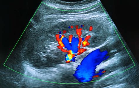 Renal Artery Ultrasound and Abdominal Aortic Ultrasound - Cardiology ...