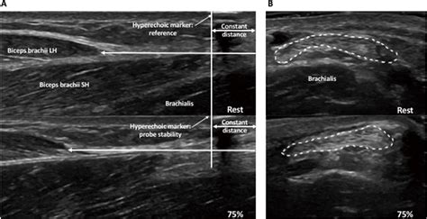 Repeatability of ultrasound in assessment of distal biceps brachii ...