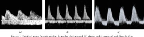 [PDF] Postnatal Systemic Blood Flow in Neonates with Abnormal Fetal Umbilical Artery Doppler ...