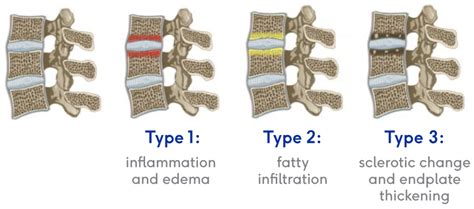 Modic Changes - The Intracept Procedure by Relievant