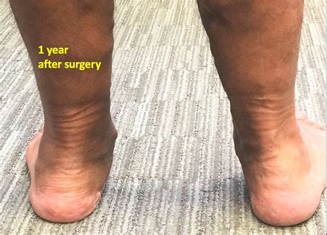 Adult Flatfoot Surgery — David Redfern Surgery