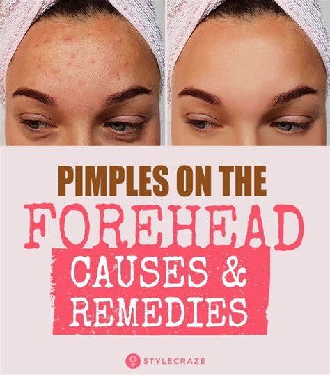 How To Get Rid Of Pimples On Forehead | Pimples on forehead, Forehead acne, Forehead acne cause