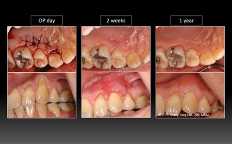 Root Coverage – Double Pedicle Graft – Case A | 藍正邦 Cheng-Pang Lan, DDS, MDSc