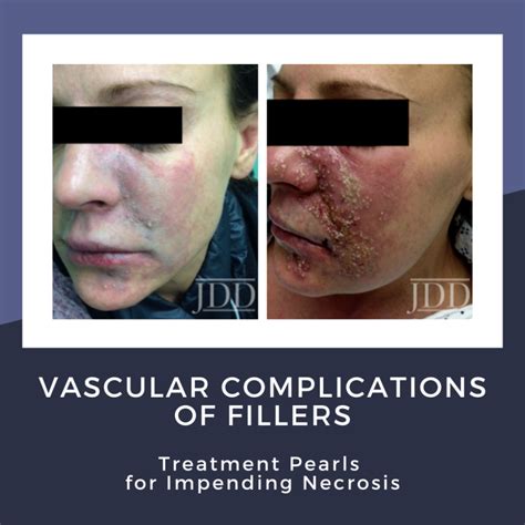 Vascular Complications of Fillers: Treatment Pearls for Impending ...