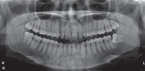 Postoperative OPG radiograph of case no 3 | Download Scientific Diagram