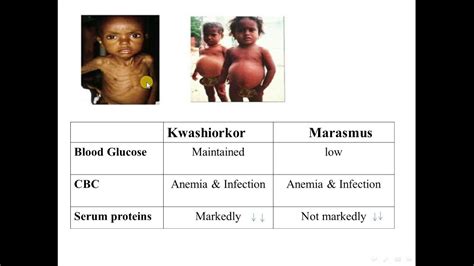 Kwashiorkor and marasmus- Comparison - YouTube