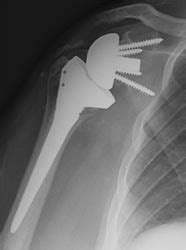 DePuy Delta Reverse Shoulder Prostheses