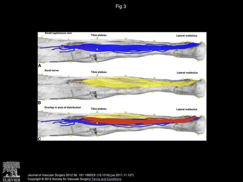 The surgical anatomy of the small saphenous vein and adjacent nerves in relation to endovenous ...