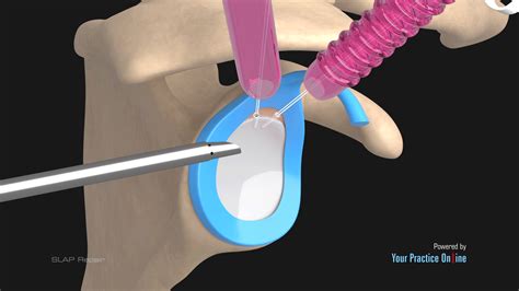 SLAP Repair Video | Medical Video Library