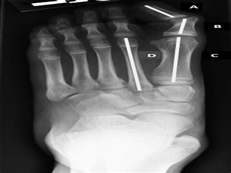 Great Toe Interphalangeal Fusion for Hallux Valgus Interphal... : Journal of Pediatric Orthopaedics