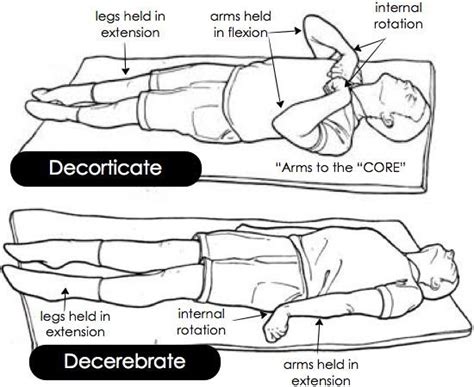 Decerebrate and decorticate posturing | Nursing programs, Nursing school prerequisites, Nursing ...