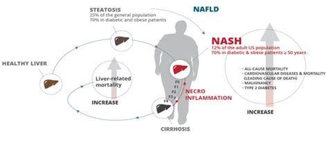 NASH Drugs: A Comprehensive Review Of Current Clinical Trials (OTCMKTS ...