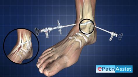 Ankle Arthroscopy-Diagnostic Procedure - YouTube