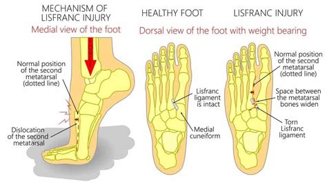 Midfoot Spain: What is it, Diagnosis and Treatment Guidelines