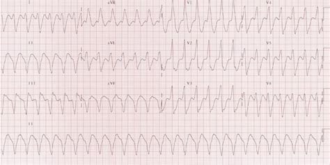 R wave • LITFL • ECG Library Basics