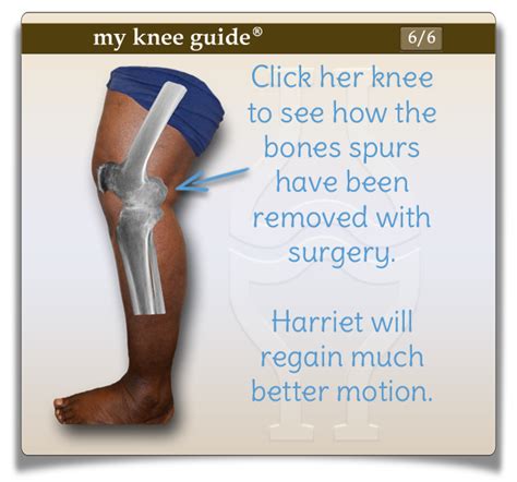 Harriet: Large bone spurs were removed from the back of Harriet’s