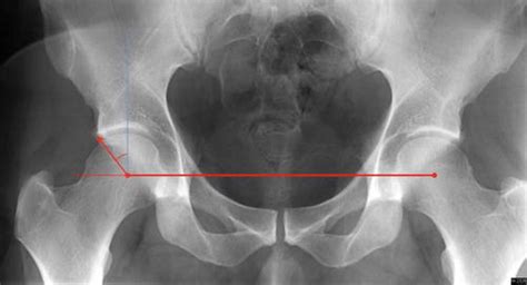 Acetabular Retroversion | Musculoskeletal Key