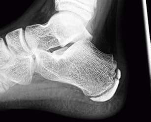 Calcaneal Apophysitis (Severs Disease) | Footdoctor