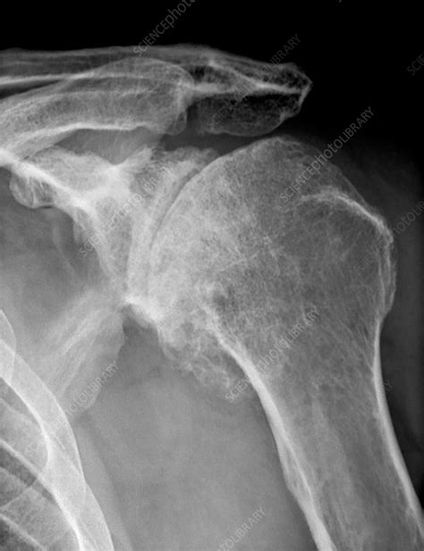 Osteoarthritis of the shoulder, X-ray - Stock Image - C037/2762 ...