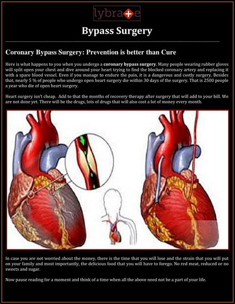 PPT - Bypass Surgery - Lybrate PowerPoint Presentation, free download ...