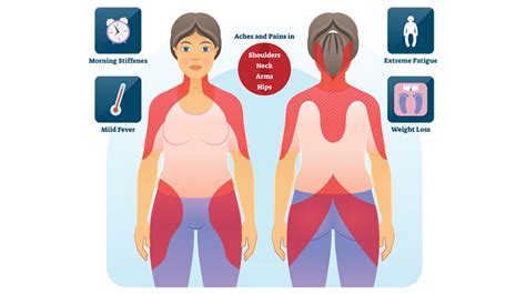 Polymyalgia Rheumatica - Arthritis Treatment Center