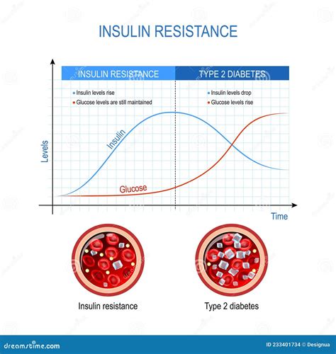 Insulin Resistance and Type 2 Diabetes Stock Vector - Illustration of ...