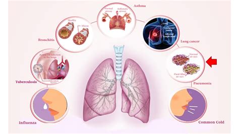 Science - Respiratory Diseases / Disorders of Respiratory System ...