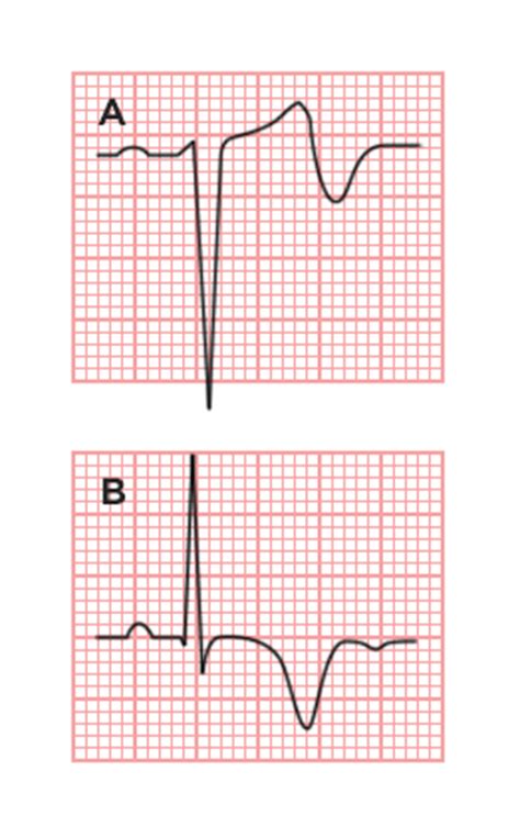 Differential Diagnosis of Wellens Syndrome