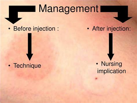 PPT - Injection Site Reaction PowerPoint Presentation, free download - ID:3111753