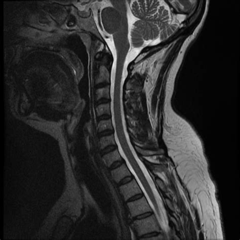 A herniated cervical disc self-diagnosis | WOORIDUL SPINE HOSPITAL ...