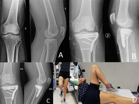 Tibial plateau fracture Schatzker II treated with ORIF followed by... | Download Scientific Diagram