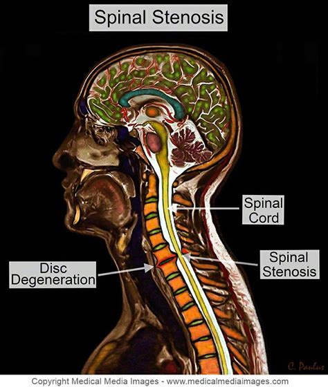 Die besten 25+ Stenosis of the spine Ideen auf Pinterest | degenerative ...